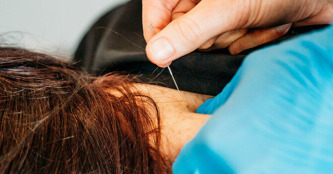 Trigger Point Dry Needling