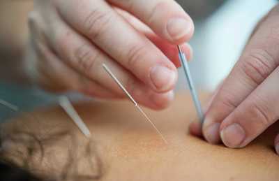 Link to: /programs/acupuncture